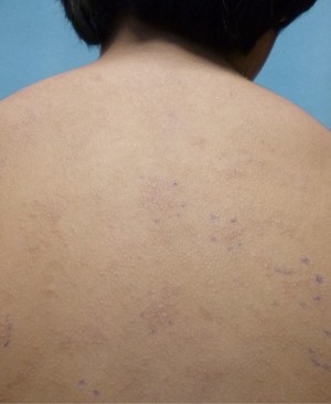 Nickel Rash iPad Nickel Rash iPad