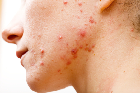 26901643 - acne skin because the disorders of sebaceous glands productions
