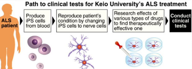 Keio Univ. clinical tests to use Parkinson’s drug for ALS