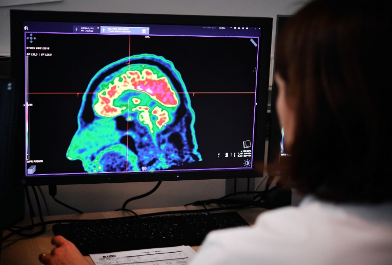 Women's brains appear 'years younger' than men's – study