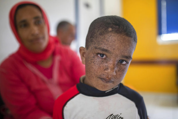 When light is lethal: Moroccans struggle with skin disorder