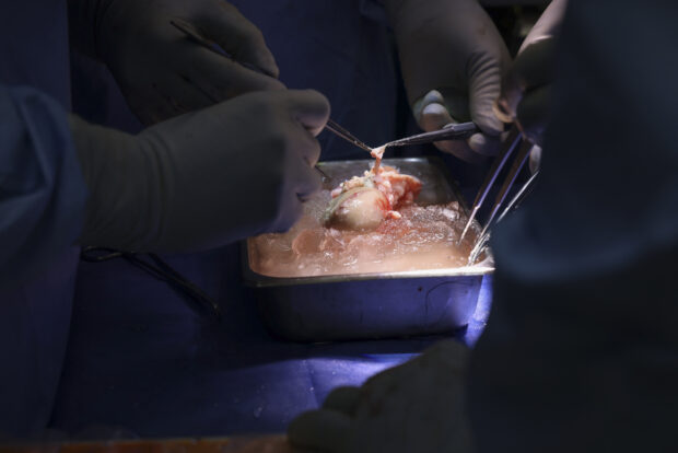 US surgeons perform first pig-to-human kidney transplant